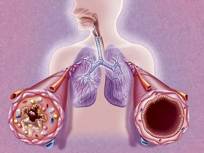 درک آسم و نقش شنا در مدیریت آن