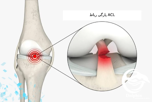 آسیب زانو (Breaststroke Knee): ضربه‌های مکرر